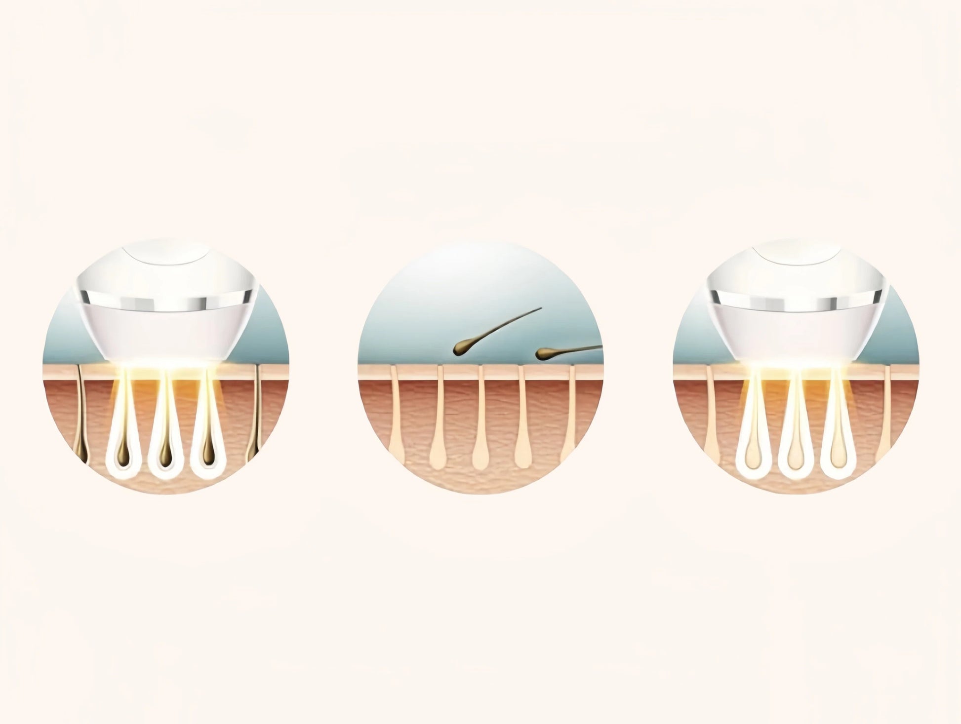 Illustration showing how Philips Lumea Advanced uses targeted light energy to damage hair follicles, reduce regrowth, and achieve long-term hair reduction with minimal discomfort.